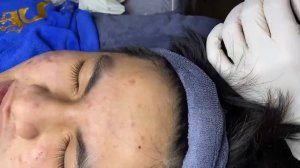 Acne collection • A008 • Архив SacDepSpa • АСМР