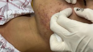 Acne collection • A005 • Архив SacDepSpa • АСМР