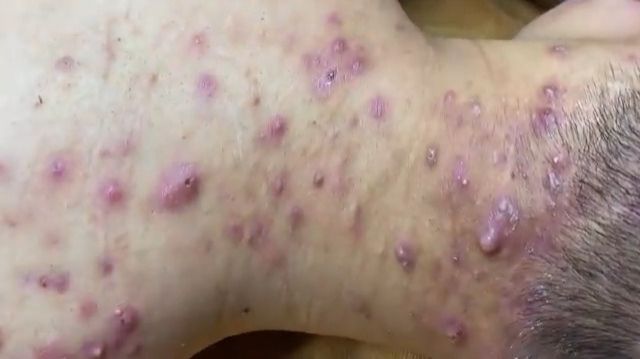 Acne collection • A011 • Архив SacDepSpa • АСМР смотреть онлайн