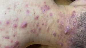 Acne collection • A011 • Архив SacDepSpa • АСМР