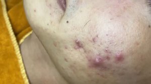Acne collection • A007 • Архив SacDepSpa • АСМР