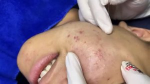 Acne collection • A013 • Архив SacDepSpa • АСМР