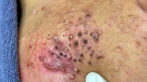Удаление черных точек в Sac Dep Spa