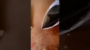 Уход за кожей | Удаление чёрных точек пинцетом