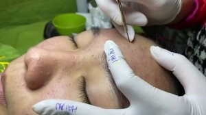 Маленькие прыщики как иголки на лице — удаление закрытых комедонов