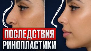 Ринопластика: что нужно знать ПЕРЕД операцией? Ошибки, советы, изменения лица