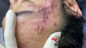 288 • Acne collection • АСМР • Relax Spa