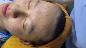 Удаление черных точек и прыщей у девушки-подростка