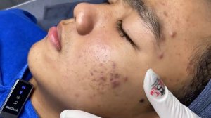 313 • Acne collection • АСМР • Relax Spa