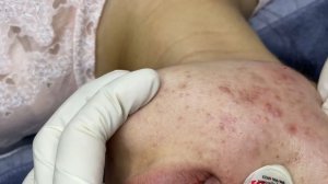 318 • Acne collection • АСМР • Relax Spa