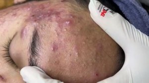 287 • Acne collection • АСМР • Relax Spa