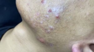 Acne collection • A014 • Архив SacDepSpa • АСМР
