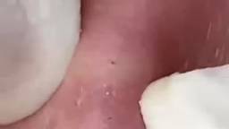 Экстремальное удаление черных точек 🧖♀️ Расслабляющее видео