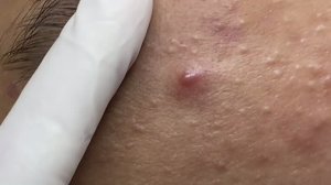 Удаление подкожных прыщей — скрытые комедоны