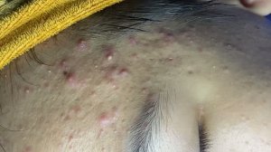 Удаление акне и чистка за проблемной кожей