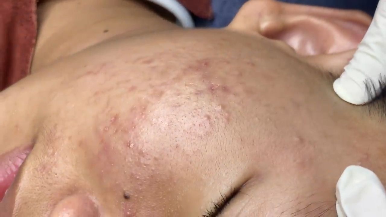 304 • Acne collection • АСМР • Relax Spa смотреть онлайн