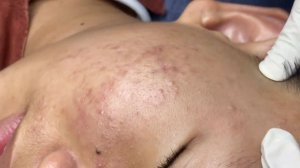 304 • Acne collection • АСМР • Relax Spa