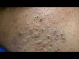 Глубокое удаление черных точек и уход за лицом | Очень приятно!