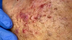 Удаление черных точек в Sac Dep Spa