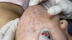 317 • Acne collection • АСМР • Relax Spa