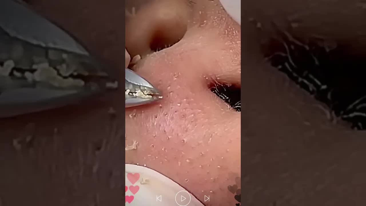 Удаление черных точек пинцетом 🧴 #skincare #blackheads смотреть онлайн