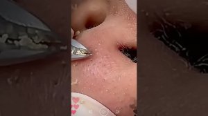 Удаление черных точек пинцетом 🧴 #skincare #blackheads