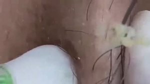 Экстремальное удаление черных точек. Удовлетворение и релакс