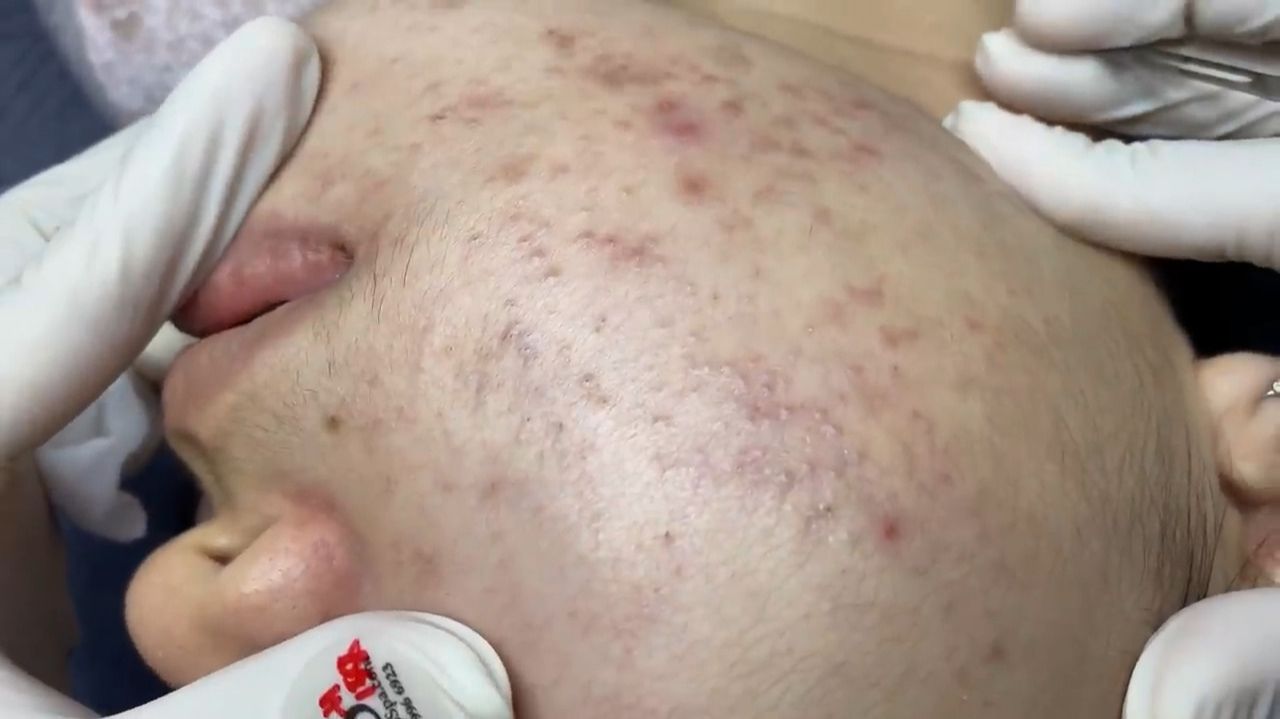 316 • Acne collection • АСМР • Relax Spa смотреть онлайн