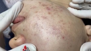 316 • Acne collection • АСМР • Relax Spa