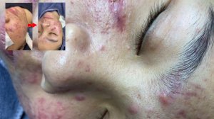 306 • Acne collection • АСМР • Relax Spa