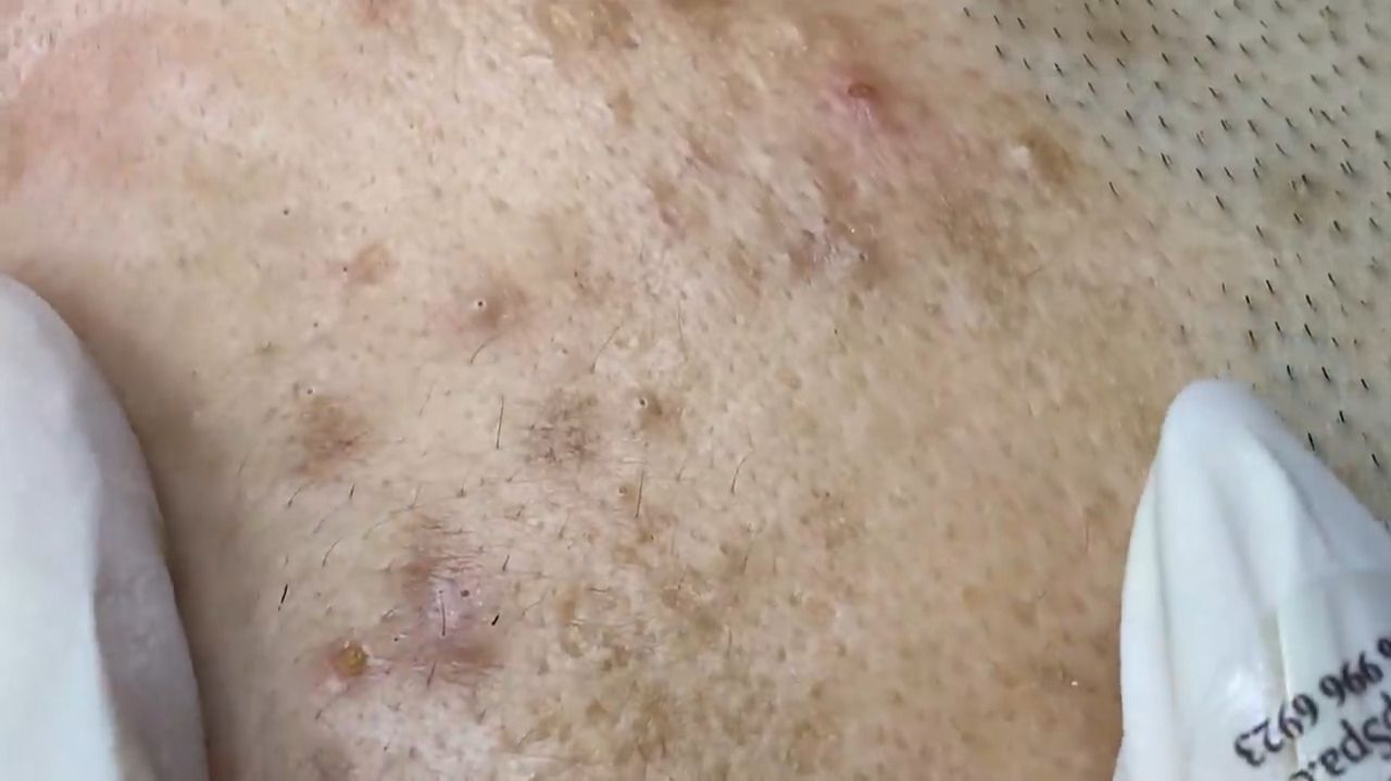 315 • Acne collection • АСМР • Relax Spa смотреть онлайн