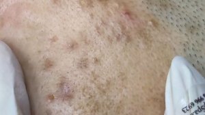 315 • Acne collection • АСМР • Relax Spa