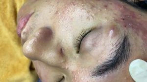 286 • Acne collection • АСМР • Relax Spa
