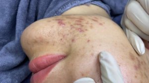 314 • Acne collection • АСМР • Relax Spa