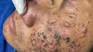 Извлечение черных точек с Sac Dep Spa @880