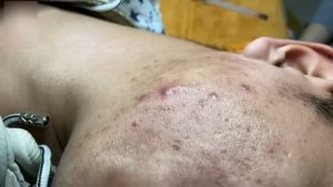#491 Удаление акне. Экстракция комедонов. Подкожные прыщи. Чистка от черных точек