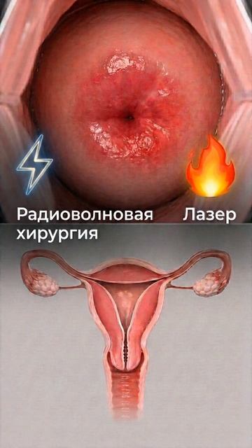 Эрозия шейки матки: лечить или наблюдать? Важный ответ