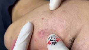 Acne collection • A018 • Архив SacDepSpa • АСМР