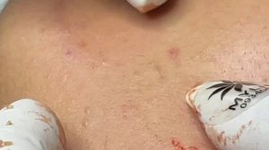 Ручная чистка лица — удаление несовершенств
