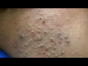 Агрессивное удаление черных точек и прыщей | Корейский уход за кожей