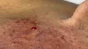 Удаление прыщей ручным способом