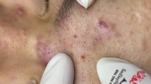 323 • Acne collection • АСМР • Relax Spa