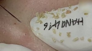 #495 Удаление акне. Экстракция комедонов. Подкожные прыщи. Чистка от черных точек