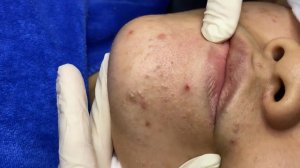 322 • Acne collection • АСМР • Relax Spa