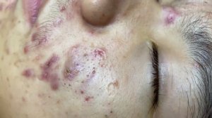 321 • Acne collection • АСМР • Relax Spa