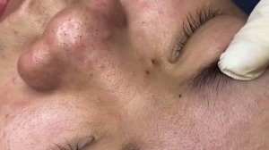 324 • Acne collection • АСМР • Relax Spa