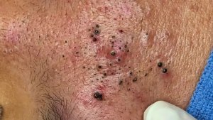 Удаление черных точек от Sac Dep Spa