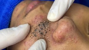 Удаление чёрных точек в Sac Dep Spa