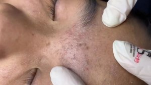 320 • Acne collection • АСМР • Relax Spa