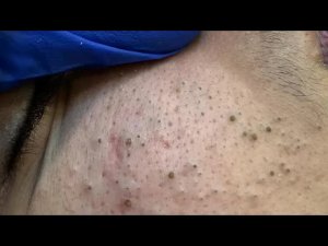 Я попробовал корейский уход от черных точек — результаты 30-дневного челленджа
